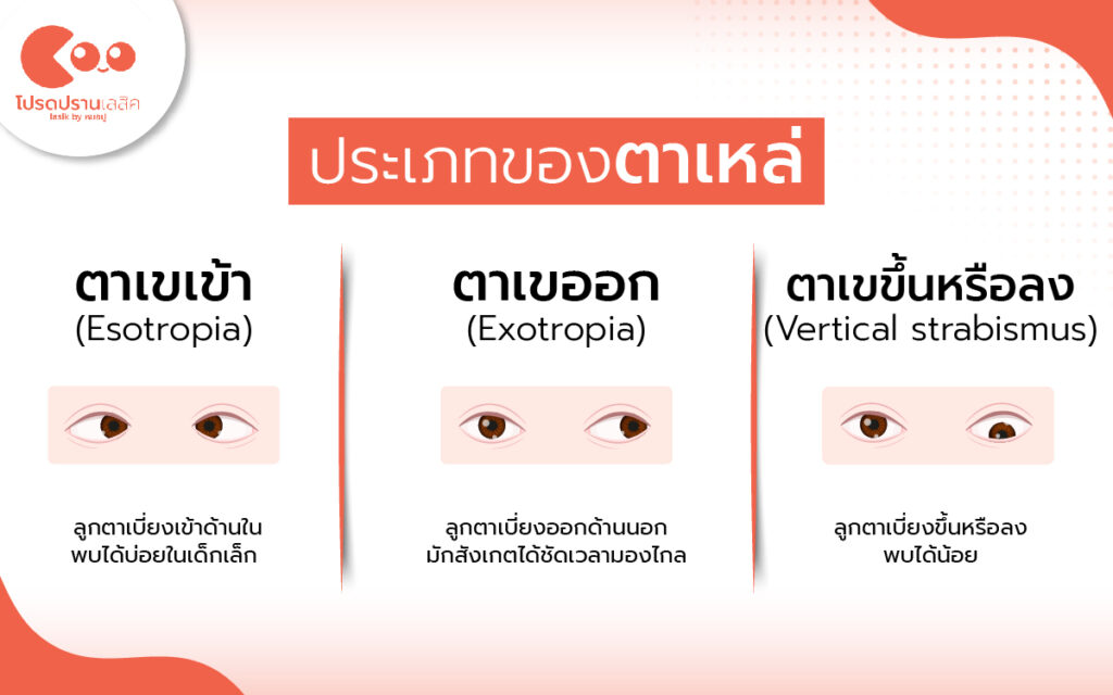 ประเภทของตาเหล่