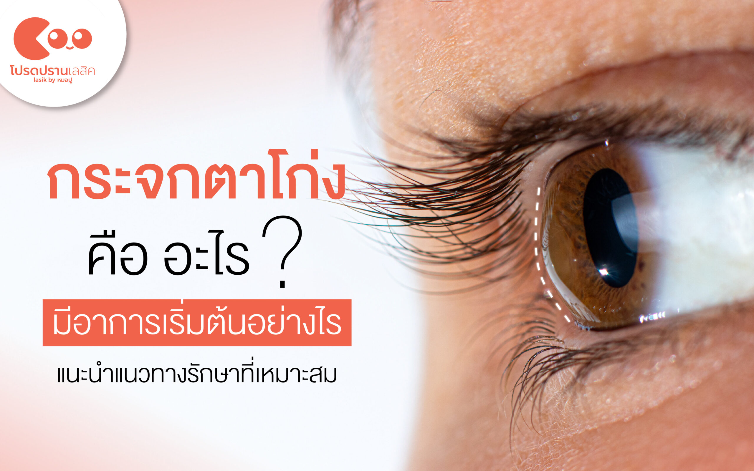กระจกตาโก่ง Keratoconus คืออะไร สาเหตุ