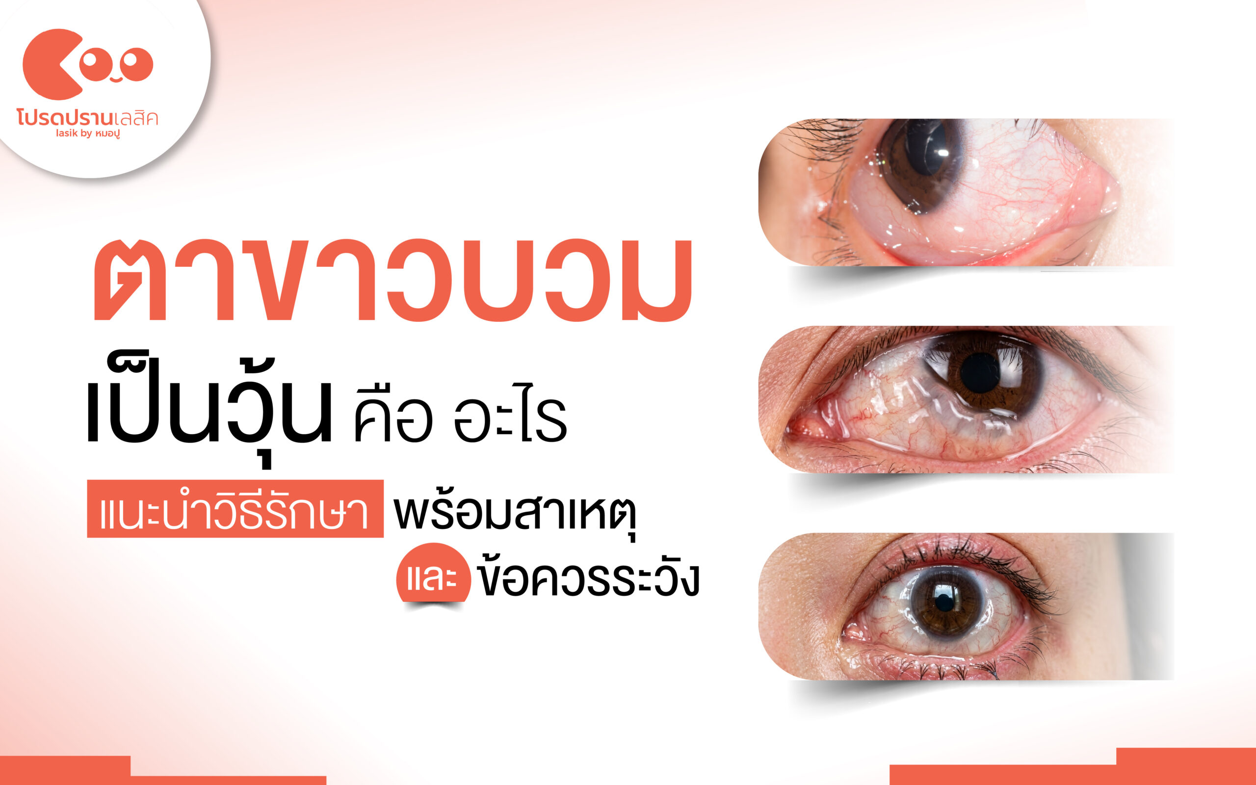 ตาขาวบวมเป็นวุ้น chemosis คืออะไร